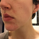 Illustration for article titled It Puts the ??? On Its Skin: Breaking Through My Breakouts